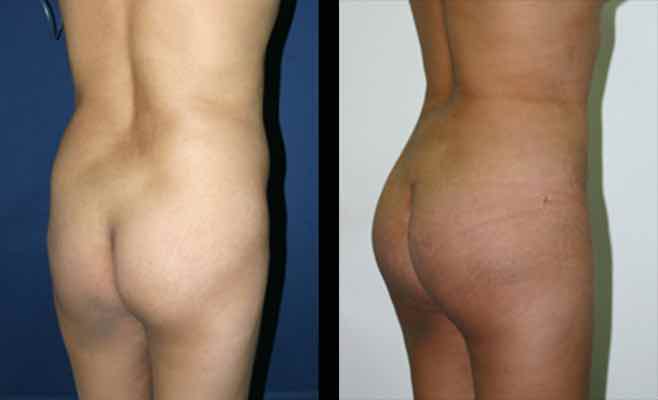 fotos antes y despues implantes gluteos