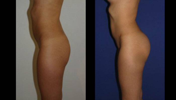 fotos antes y despues implantes gluteos