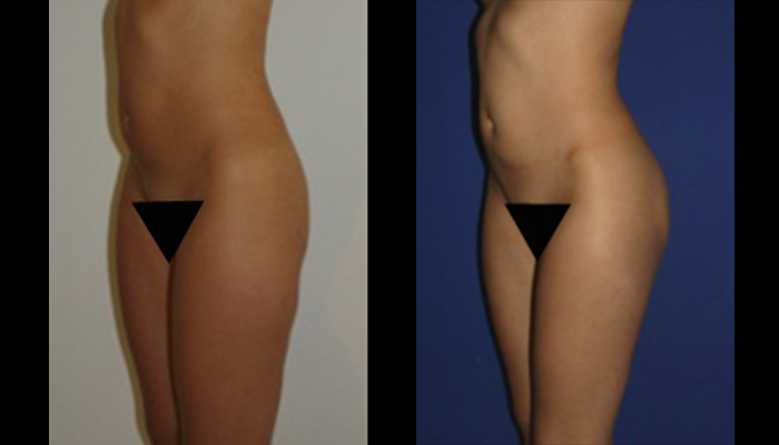 fotos antes y despues implantes gluteos