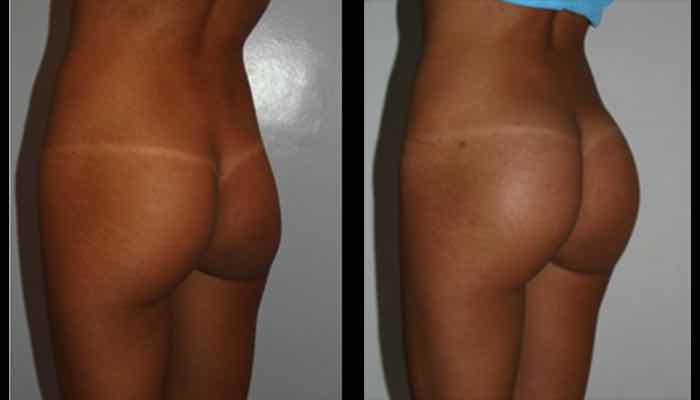 fotos antes y despues implantes gluteos