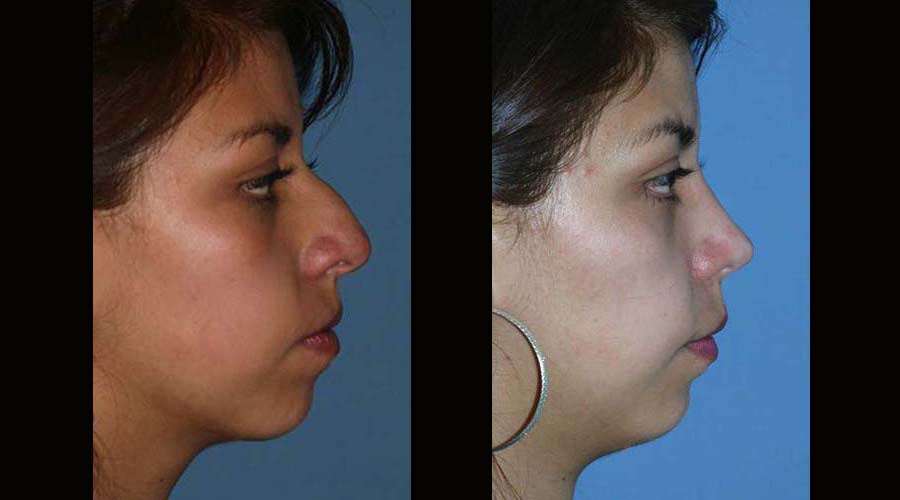 Fotos rinoplastia antes y despues 5