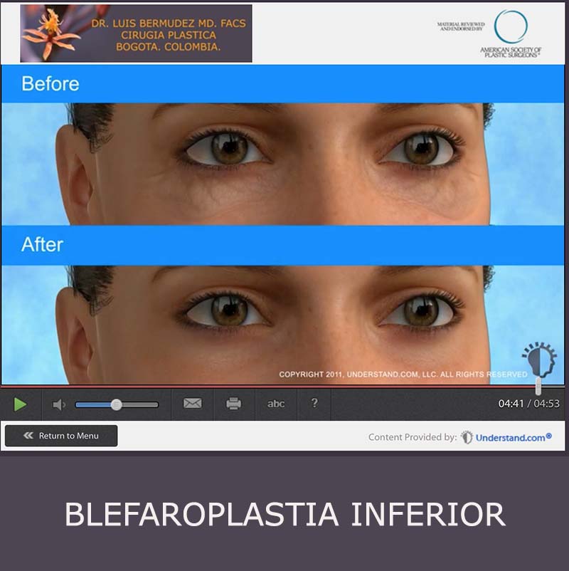 boton animacion blefaroplastia