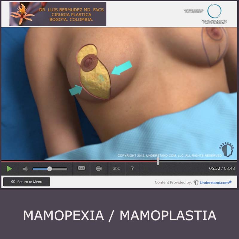 boton animacion mamoplastia