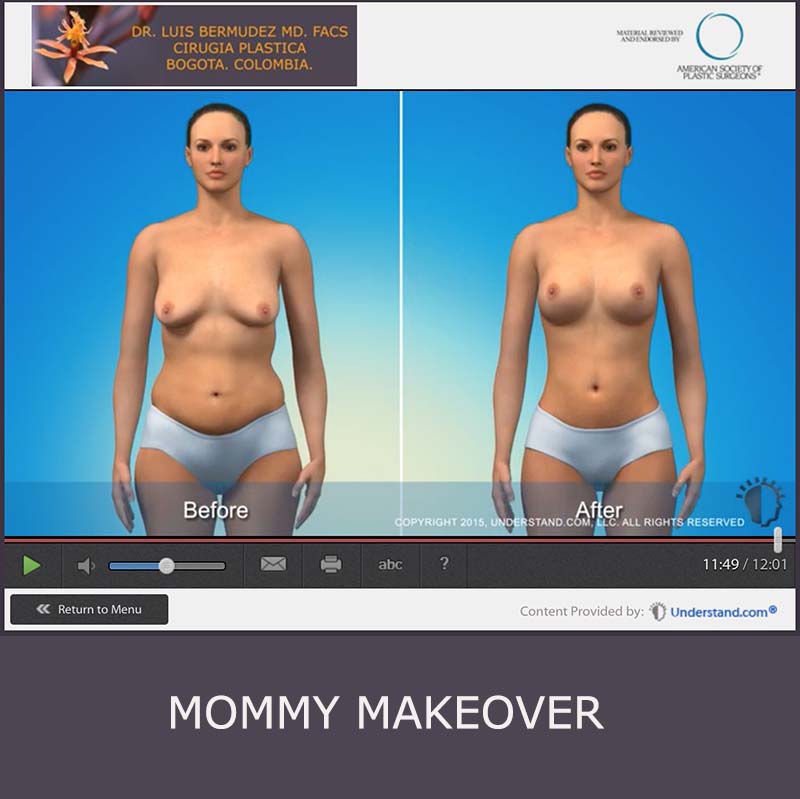 boton mommy makeover