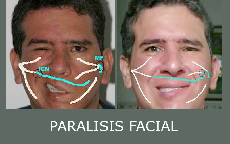 boton paralisis facial