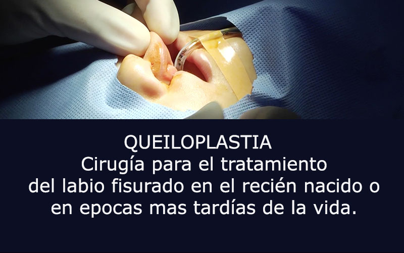 boton queiloplastia